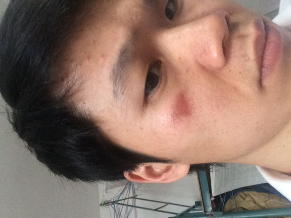 色素疤痕 激光过后留下的色素沉着更严重了 .